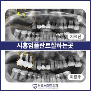 장곡동임플란트