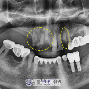 장곡동임플란트잘하는곳