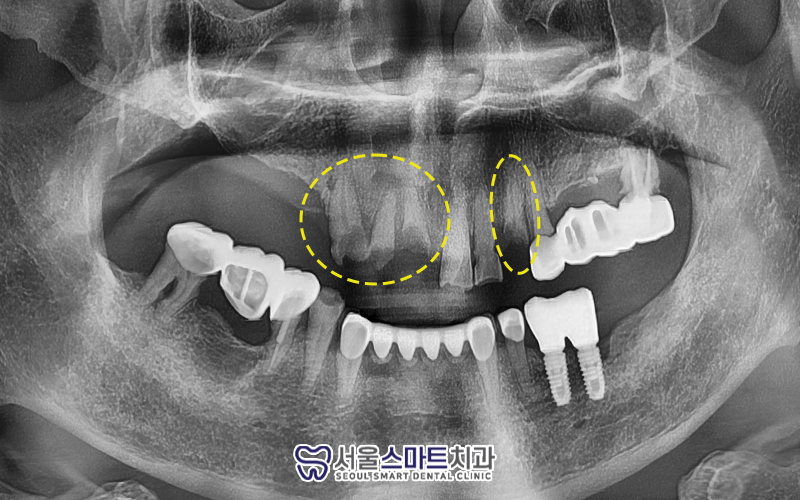 장곡동임플란트잘하는곳