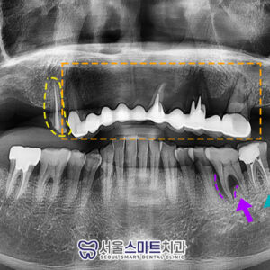 배곧임플란트잘하는곳