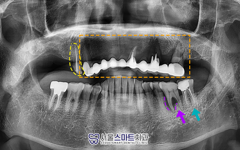배곧임플란트잘하는곳