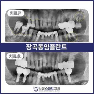 장곡동임플란트