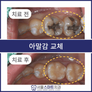 서울스마트치과_전후탬플릿_복사본-001