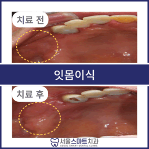 서울스마트치과_전후탬플릿_복사본-001