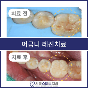 서울스마트치과_전후탬플릿_복사본-001